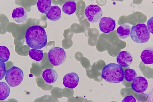 Diferencia entre la leucemia mieloide aguda (LMA) y otros cánceres de la sangre