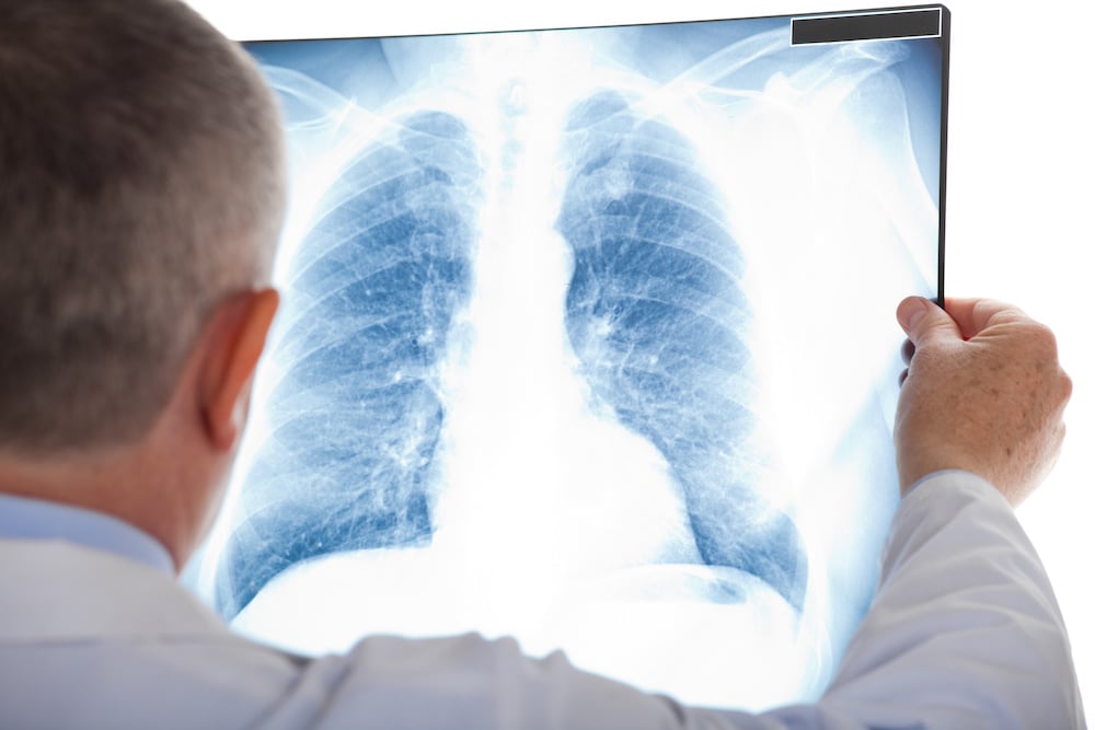 What to Expect After a Lung Nodule Diagnosis