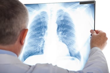 Qué esperar tras el diagnóstico de un nódulo pulmonar