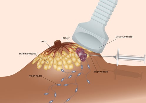 Biopsia de una mama