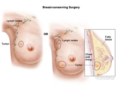 Консервирующая хирургия молочной железы у женщин