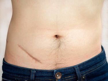 man with surgical scar deals with feeling less sexy after cancer treatment