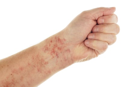 petechiae red dots under skin