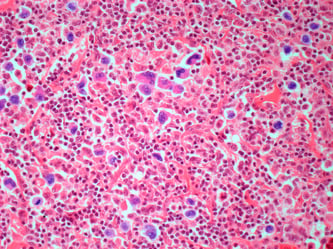 Células de linfoma de Hodgkin vistas al microscopio.