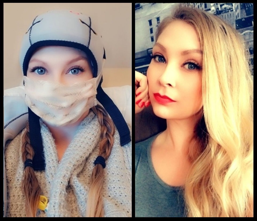 imágenes del antes y el después de una mujer que perdió el pelo durante el tratamiento contra el cáncer