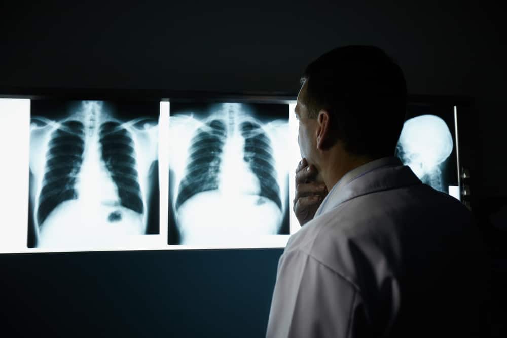 doctor looking at lung xrays