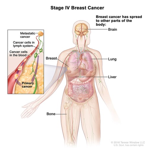 Ilustración médica que muestra cómo, en el estadio IV, el cáncer de mama se ha extendido a otras partes del cuerpo como el cerebro, los pulmones, el hígado, los huesos, el sistema linfático o la sangre.