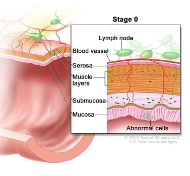 Ilustración médica que muestra el estadio 0 del cáncer colorrectal. Hay células anormales en la capa más interna del colon, llamada mucosa.