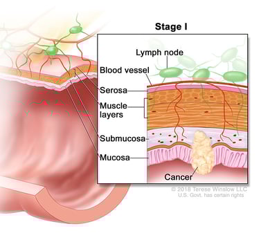 Ilustración médica que muestra el estadio 1 del cáncer colorrectal. Hay células cancerosas en las dos capas internas del colon, la mucosa y la submucosa.