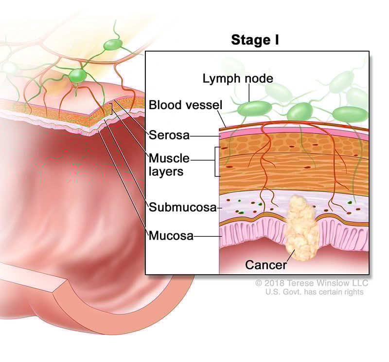 colorectal-ca-stage-1