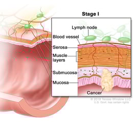 colorectal-ca-stage-1