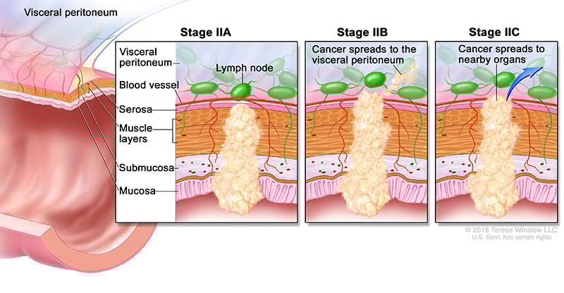 Ilustración médica del estadio 2 del cáncer colorrectal que muestra la propagación de las células cancerosas a través de las cuatro capas del colon en el estadio IIA y hacia el peritoneo visceral en el estadio IIB. En el estadio IIC, el cáncer se extiende a los órganos cercanos.