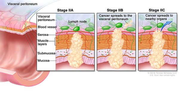 colorectal-ca-stage-2