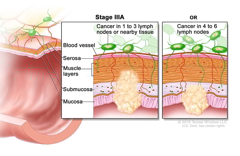Ilustración médica que muestra el estadio 3A del cáncer colorrectal. Pueden observarse células cancerosas en 1 a 3 ganglios linfáticos o tejido cercano o en 4 a 6 ganglios linfáticos.