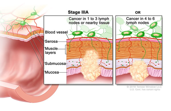 colorectal-ca-stage-3A