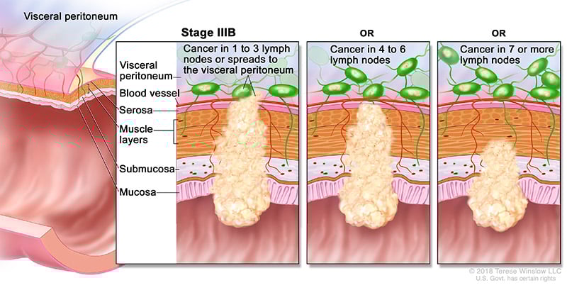 Ilustración médica que muestra el estadio 3B del cáncer colorrectal. Pueden observarse células cancerosas en 1-3 ganglios linfáticos o extendiéndose al peritoneo visceral, o en 4 a 6 ganglios linfáticos, o en 7 o más ganglios linfáticos.