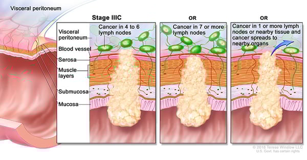 colorectal-ca-stage-3C