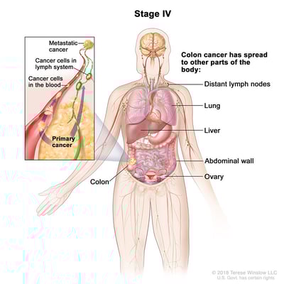 Ilustración médica que muestra el estadio 4 del cáncer colorrectal. El cáncer se ha extendido a otras partes del cuerpo.