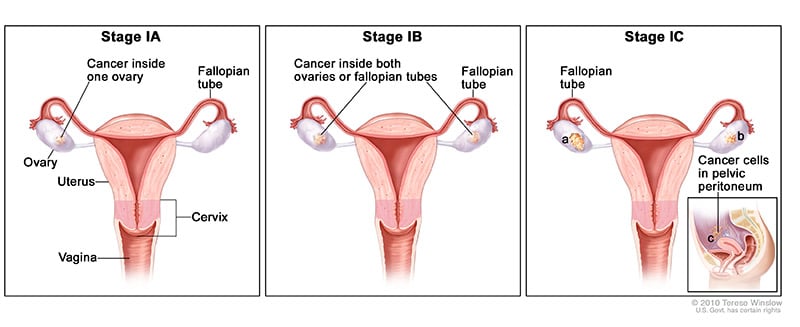 A medical illustration showing Phases 1A, B, and C of ovarian cancer.