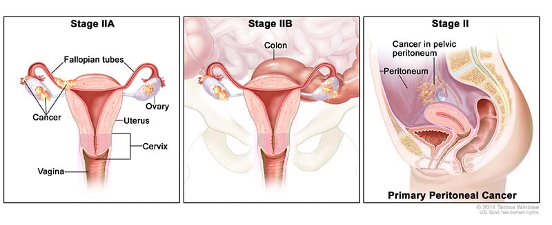 A medical drawing showing Stages 2A and B of ovarian cancer. 
