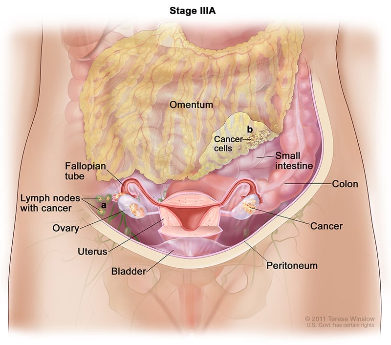 A medical drawing showing stage 3A of ovarian cancer.