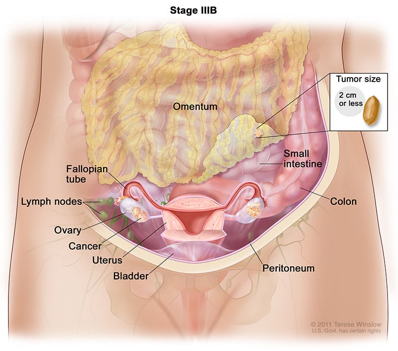 A medical drawing showing stage 3B of ovarian cancer.