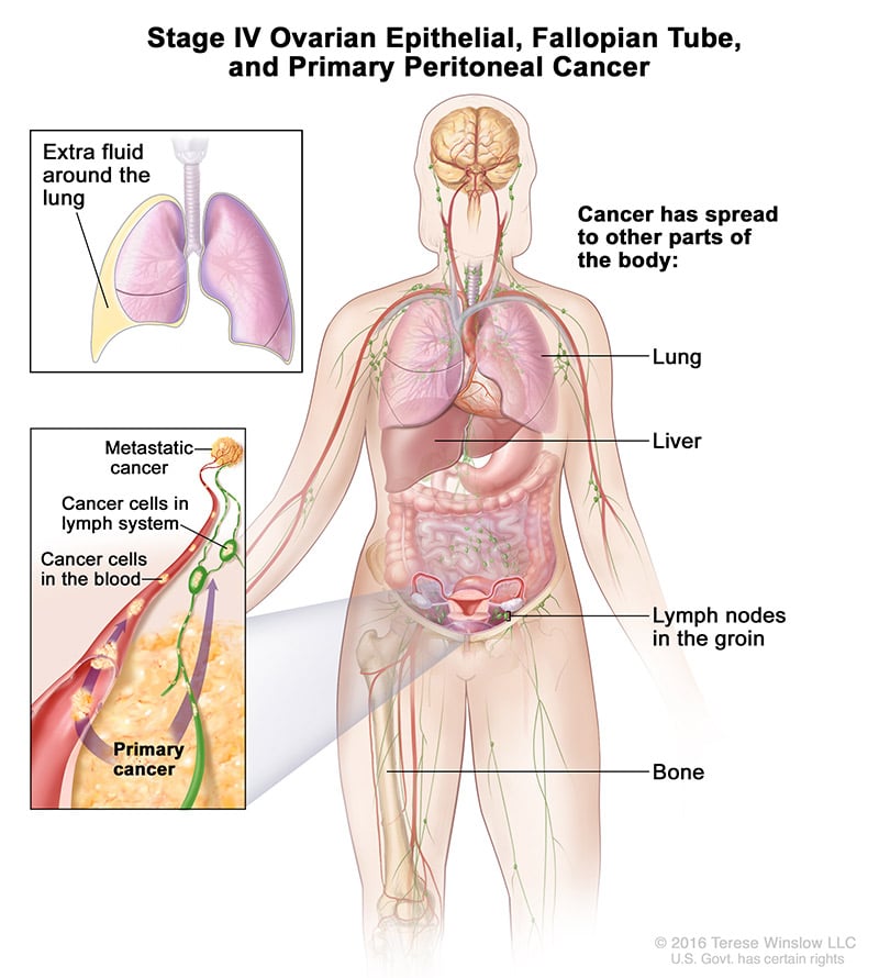 A medical drawing showing stage 4 of ovarian cancer.