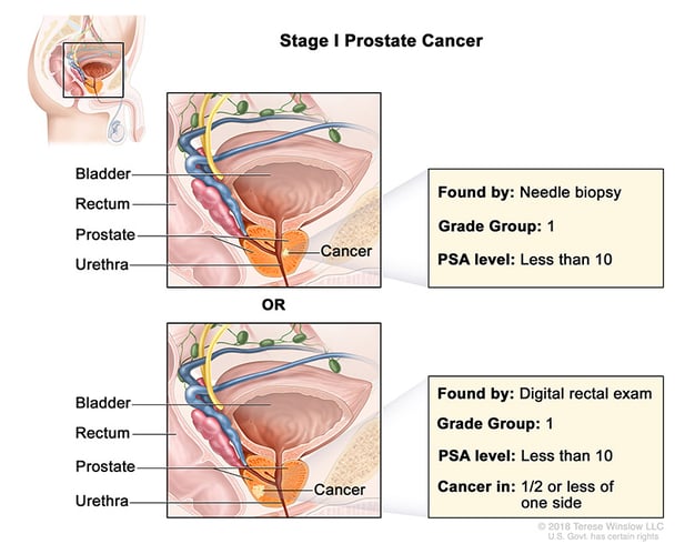 A medical illustration showing Stage 1 of prostate cancer.