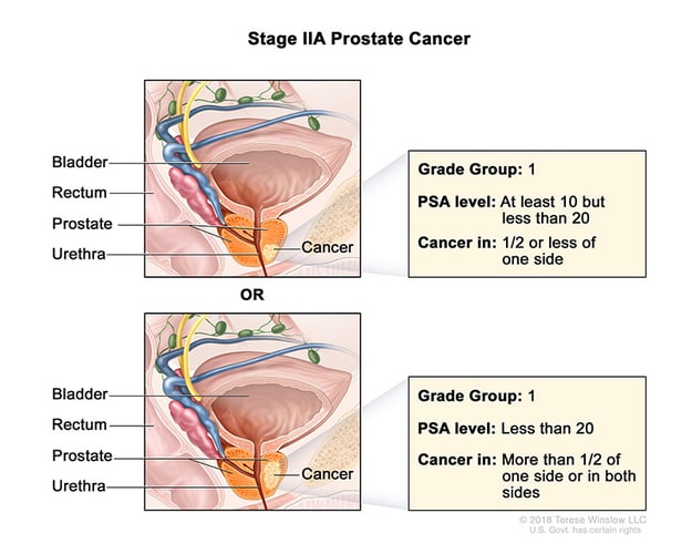 A medical illustration showing Stage 2A of prostate cancer.