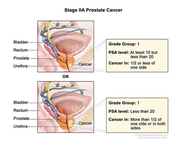 prostate-stage-2A