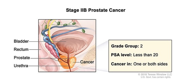 prostate-stage-2B