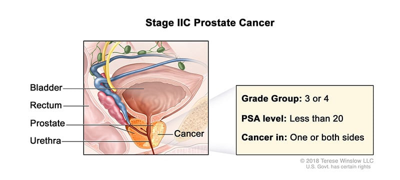 A medical illustration showing Stage 2C of prostate cancer.