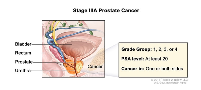 A medical illustration showing Stage 3A of prostate cancer.