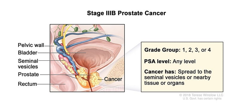 A medical illustration showing Stage 3B of prostate cancer.