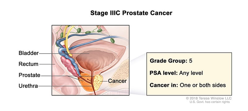 A medical illustration showing Stage 3C of prostate cancer.