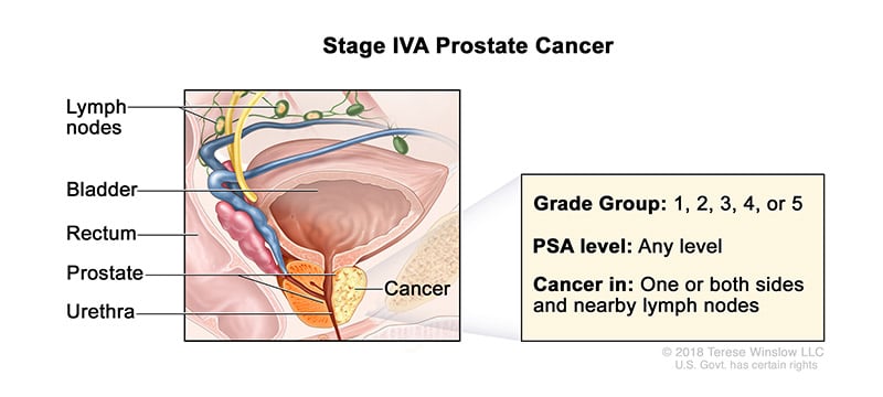 A medical illustration showing Stage 4A of prostate cancer.