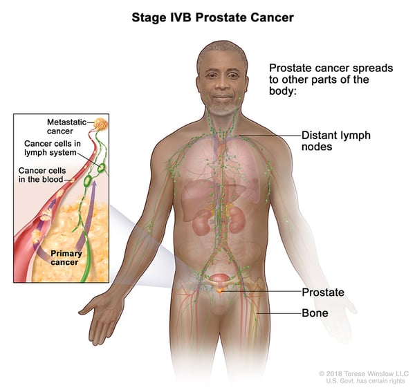 prostate-stage-4B
