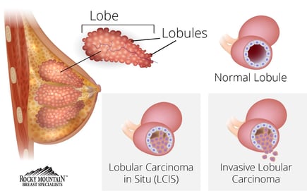 rmbs_cáncer_de_mama_lobular