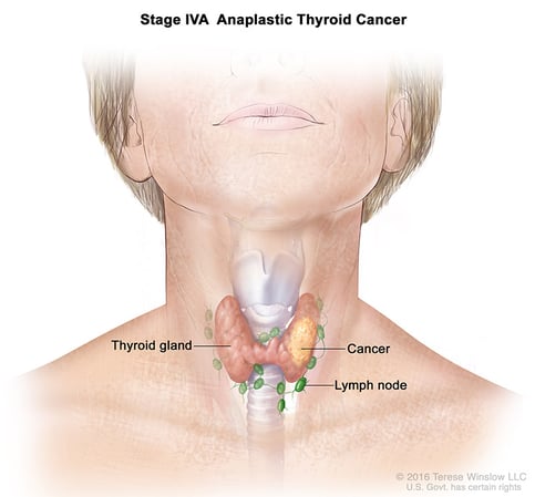 A medical illustration of stage 4A of anaplastic thyroid cancer.