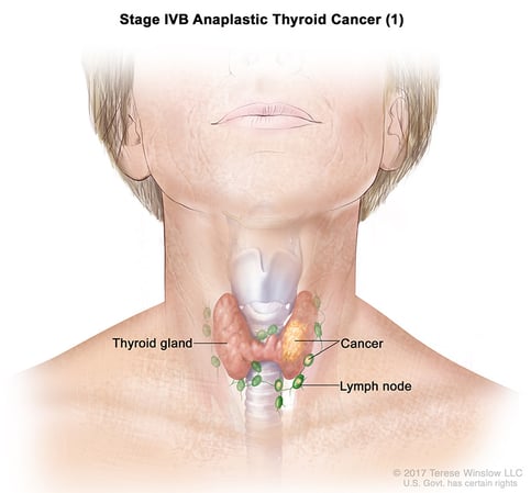 A medical illustration of stage 4B of anaplastic thyroid cancer.