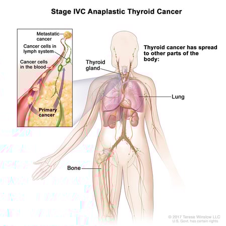 A medical illustration of stage 4C of anaplastic thyroid cancer.