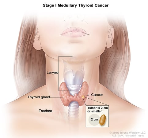 A medical illustration of stage 1 of medullary thyroid cancer.