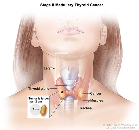 A medical illustration of stage 2 of medullary thyroid cancer.