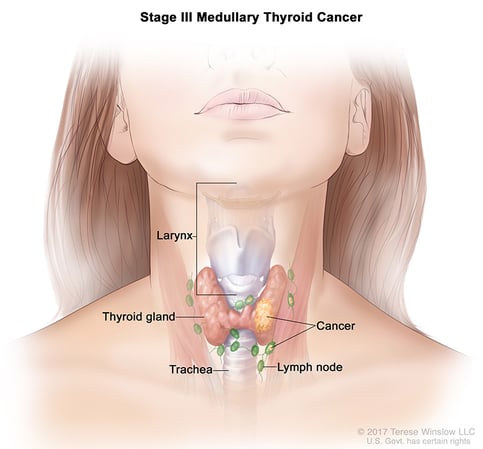A medical illustration of stage 3 of medullary thyroid cancer.