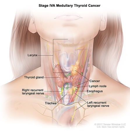 A medical illustration of stage 4A of medullary thyroid cancer.