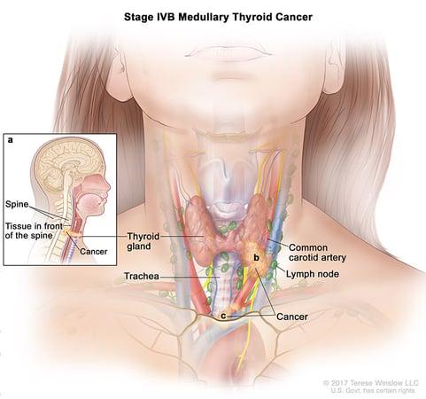 A medical illustration of stage 4B of medullary thyroid cancer.
