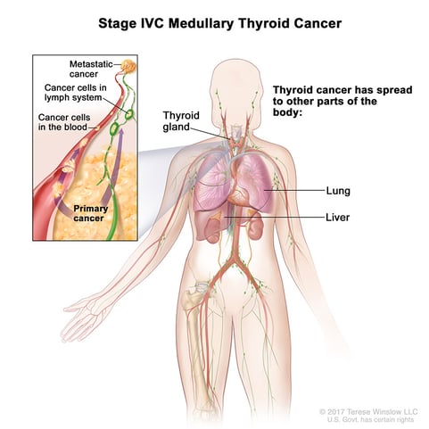 thyroid-ca-medullary-stage-4C