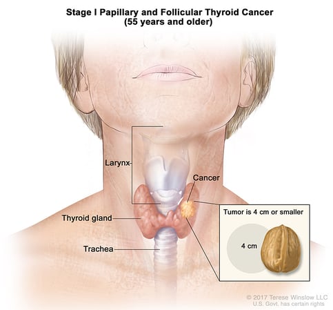A medical illustration of stage 1 of papillary and follicular thyroid cancer in people aged 55 and older.
