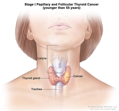 A medical illustration of stage 1 of papillary and follicular thyroid cancer in people aged 55 and younger.