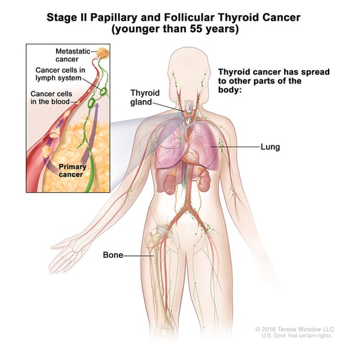 A medical illustration of stage 2 of papillary and follicular thyroid cancer in people aged 55 and younger.